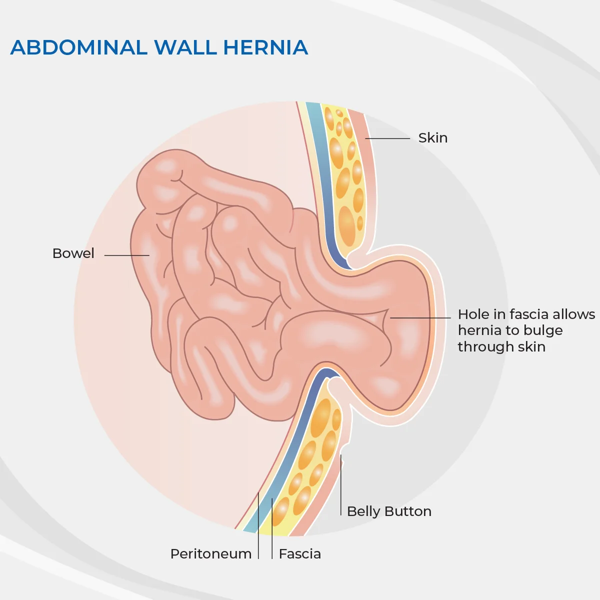 Umbilical Hernia Repair Surgery Central Coast