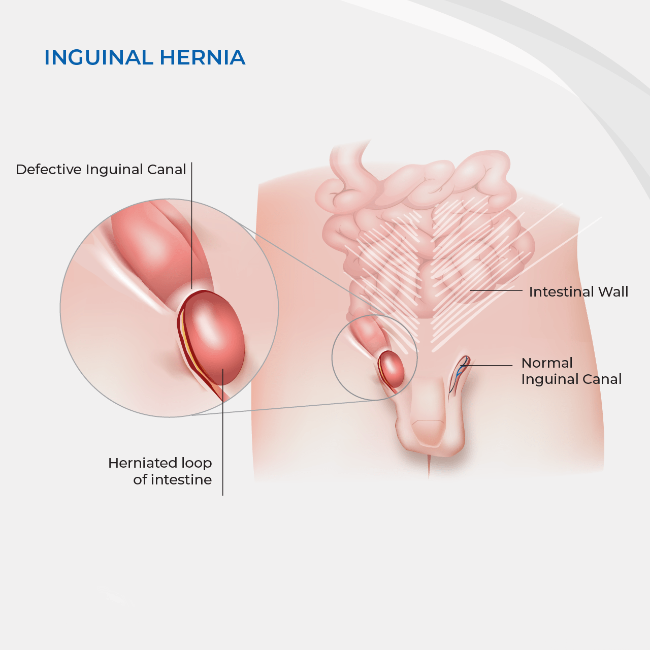 Hernia Repair (Adults) – Inguinal, Umbilical / Para-umbilical / Incisional  / Femoral Hernia – GP Gateway